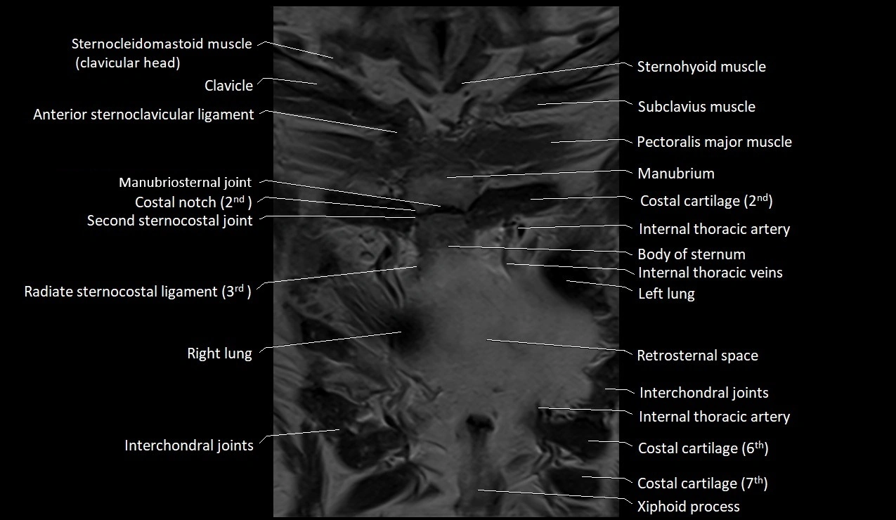 MRI sternum and sternoclavicular joint labeled coronal anatomy image 10.webp